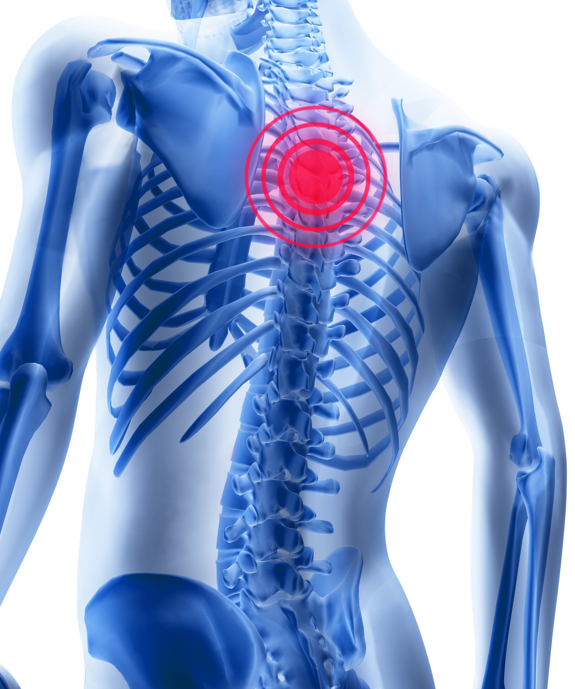 Thoracic Spine Treatment Pain and Treatment. Bra line pain? How do