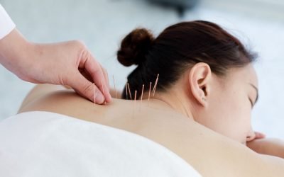Acupuncture Now Available